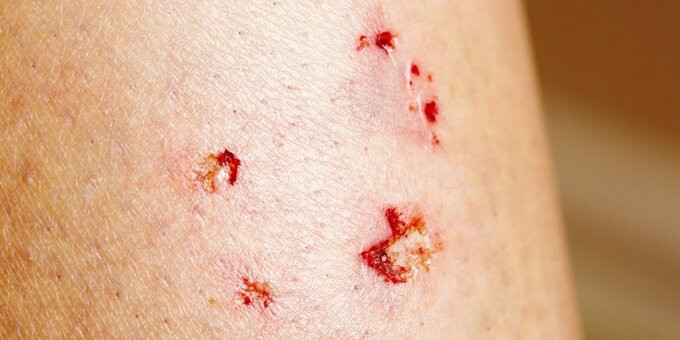 Lào Cai: Một phụ nữ 23 tuổi tử vong do bệnh dại