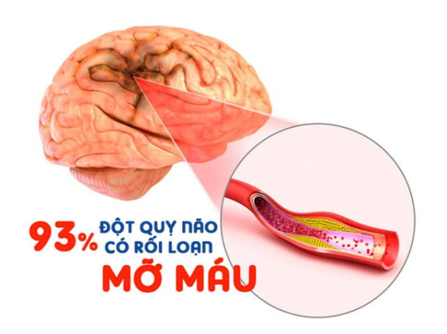 Những lời khuyên về chế độ ăn uống, tập luyện để giảm mỡ máu