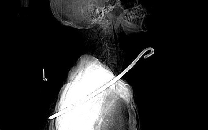 Hà Tĩnh cứu sống bệnh nhân bị một cây sắt đâm thấu cổ