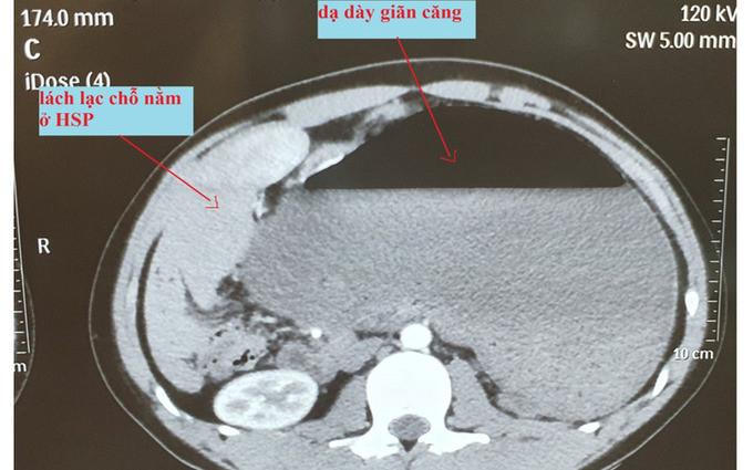 Hà Nội: Một nam thanh niên 17 tuổi bị xoắn dạ dày