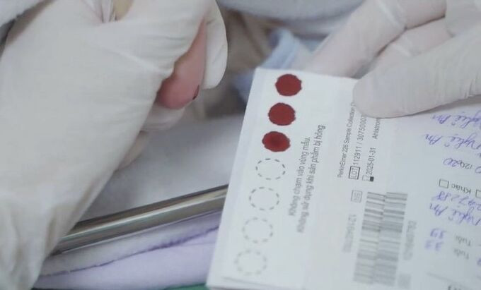 Tìm hiểu về thiếu hụt enzyme biotinidase