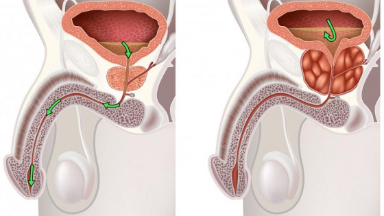 Nam y điều trị phì đại lành tính tuyến tiền liệt và ung thư tuyến tiền liệt