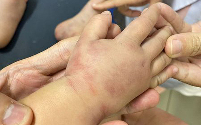 TP. HCM: Một trẻ 41 tháng tuổi mắc ban xuất huyết Henoch - Schonlein