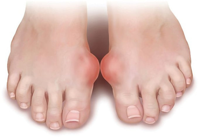 Nguyên nhân gây nên bệnh gout