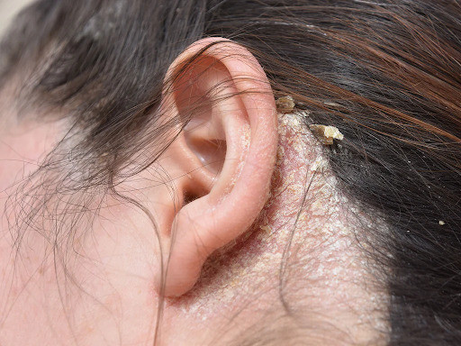 Cách trị nấm da đầu bằng muối hiệu quả nhất