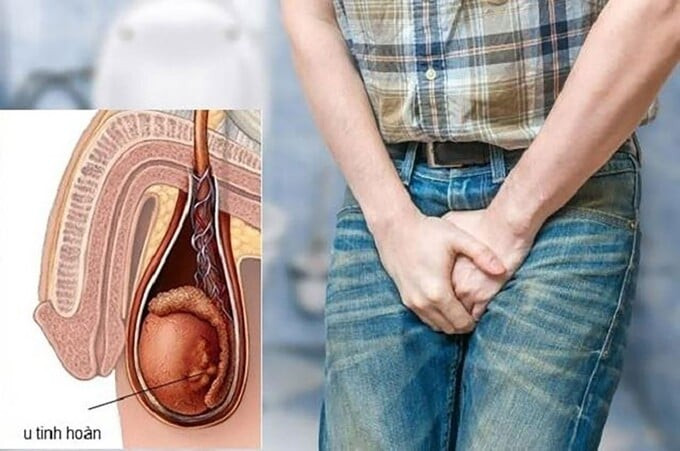 Những điều cần biết về ung thư tinh hoàn