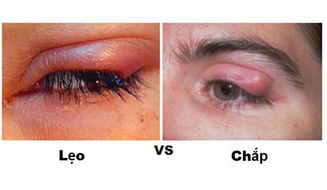 Một số cách chữa chắp, lẹo bằng mẹo