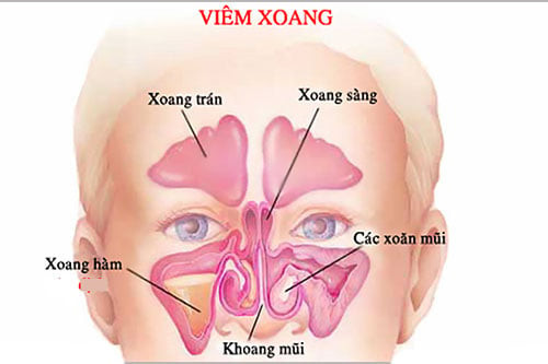 Những điều cần biết về viêm xoang trán