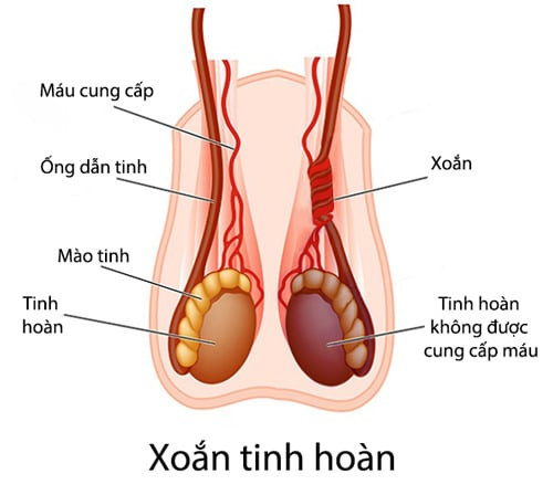 Nghệ An: Một bé trai 11 tuổi mắc chứng xoắn tinh hoàn phải mổ cấp cứu
