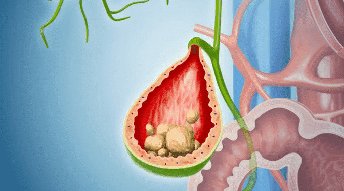 Cách trị sỏi mật tại nhà đơn giản, giảm đau nhanh, bài sỏi