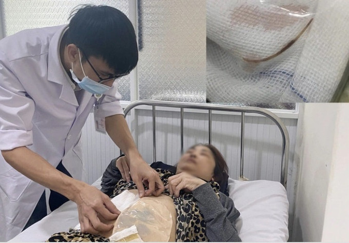 Đồng Nai phẫu thuật thành công lấy xương cá gây áp xe ổ bụng cho bệnh nhân