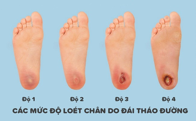 Bộ Y tế ban hành “Hướng dẫn chẩn đoán, điều trị loét bàn chân do đái tháo đường”