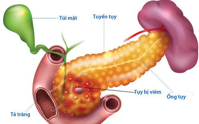 Viêm tụy cấp gây ra nhiều biến chứng ảnh hưởng lớn đến sức khỏe con người