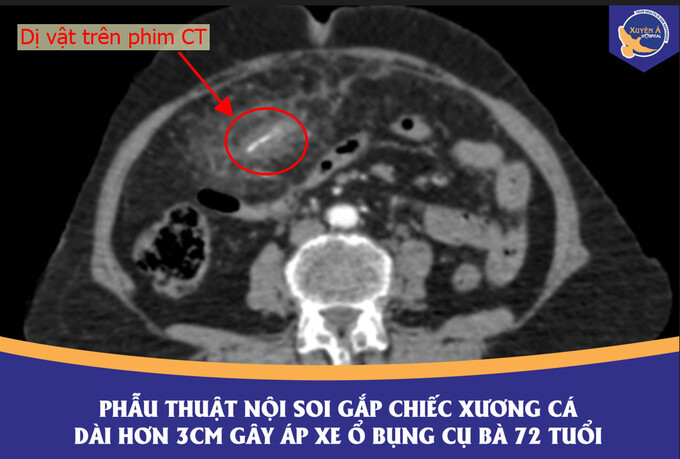 Tây Ninh phẫu thuật cấp cứu cho cụ bà 72 tuổi bị áp xe ổ bụng do mắc xương cá