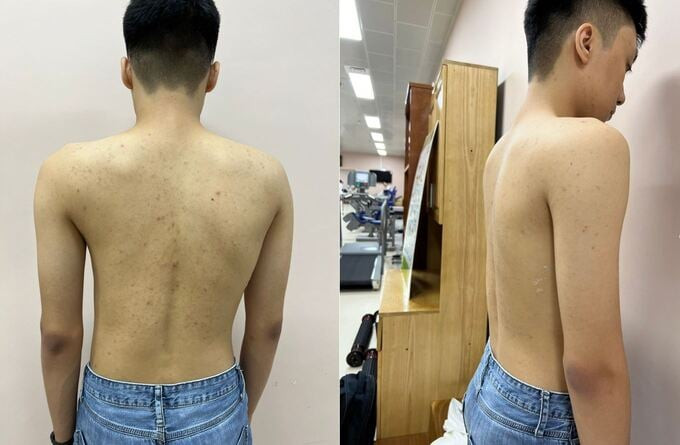 Điều trị sớm vẹo cột sống để không gây ảnh hưởng tới chất lượng cuộc sống