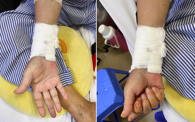 Quảng Ninh phẫu thuật cấp cứu lấy huyết khối thành công cho bệnh nhân bị tắc động mạch quay, động mạch trụ tay phải