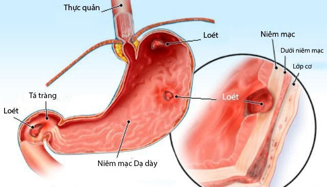 Triệu chứng và biến chứng viêm loét hành tá tràng