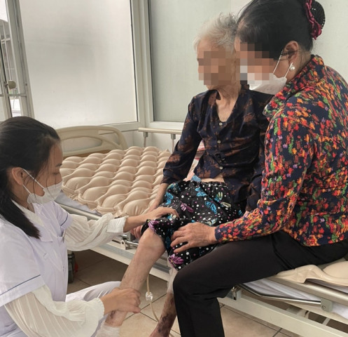 Hà Nội: Cụ bà 88 tuổi bị gãy cổ xương đùi bị hoại tử do bó thuốc nam