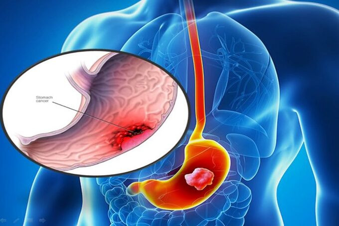 Ung thư dạ dày là một trong những bệnh lý ung thư đường tiêu hóa hay gặp nhất ở nước ta