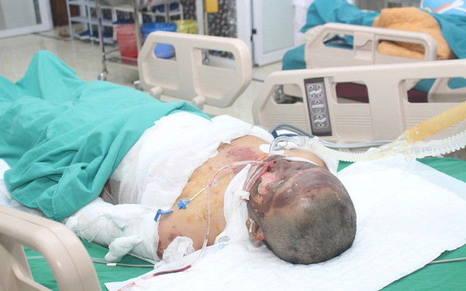 Điện Biên: Hai mẹ con bị bỏng nặng do đốt nương làm rẫy