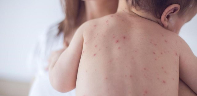 Hà Nội tiếp nhận trẻ sơ sinh 27 ngày tuổi mắc bệnh thủy đậu gây biến chứng nặng do lây từ mẹ sang