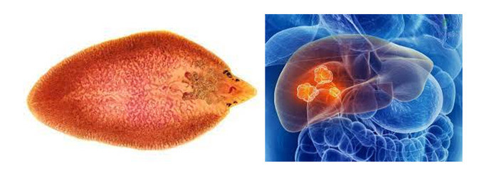 TP. HCM: Cảnh báo nhiều trường hợp bị áp xe gan do sán lá gan lớn