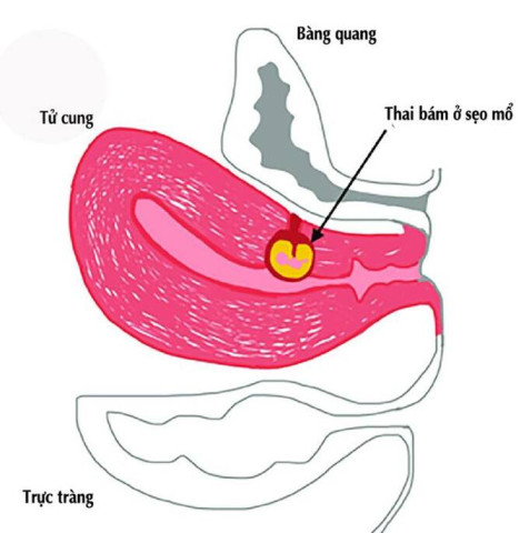 Cao Bằng phẫu thuật lấy khối thai bám sẹo mổ cũ cho thai phụ 27 tuổi