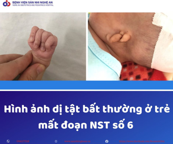 Nghệ An: Bệnh nhi 2 tháng tuổi bị viêm phổi nặng trên nền đa dị tật, rối loạn NST