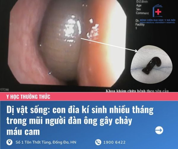 Đỉa kí sinh nhiều tháng trong mũi người đàn ông 50 tuổi gây chảy máu cam thường xuyên