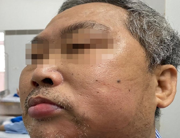 Hà Nội phẫu thuật thành công áp xe răng viêm tẩy lan tỏa vùng hàm mặt cho 1 nam bệnh nhân