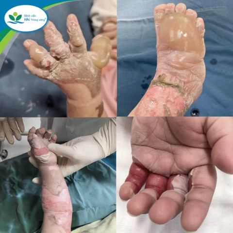 Cách sơ cứu và phòng tránh bỏng ở trẻ em