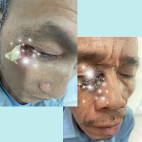 Cao Bằng: Nhiều bệnh nhân có biểu hiện ung thư da từ nốt ruồi lan rộng, có dịch, đau nhức mới đi khám