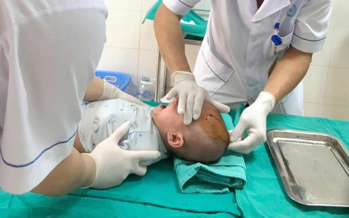 Thanh Hóa phẫu thuật thành công cho bệnh nhi 6 tháng tuổi bị chấn thương sọ não