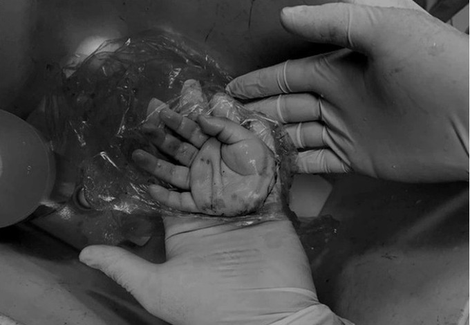 Hà Nội nối thành công bàn tay bị đứt lìa do tai nạn cho bé trai 21 tháng tuổi