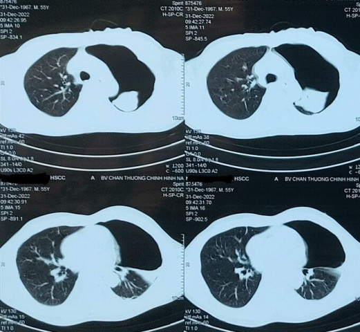 Nghệ An cấp cứu bệnh nhân bị ngã cây cao khiến chấn thương ngực nặng