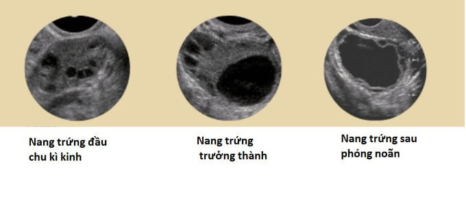 Nang trứng cần thiết cho để đánh giá về sức khỏe sinh sản của phụ nữ