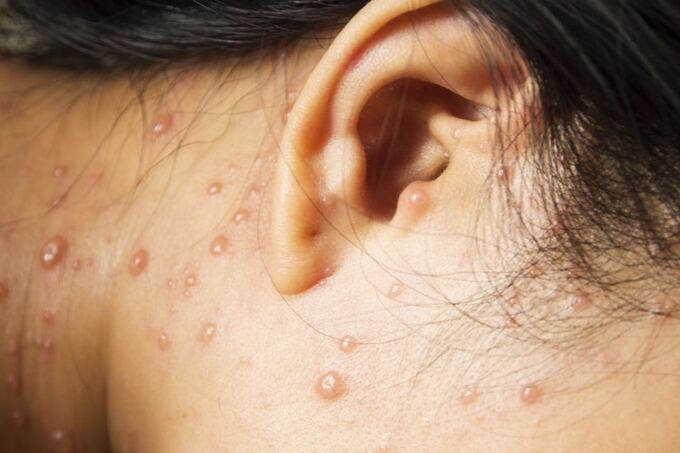 Bệnh thủy đậu và các biện pháp phòng tránh