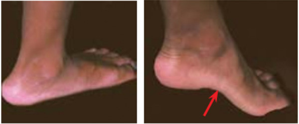 Hội chứng bàn chân bẹt ở trẻ nhỏ