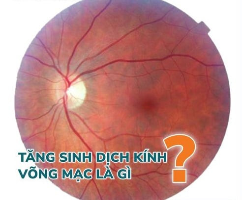 Tăng sinh dịch kính võng mạc có nguy cơ gây mù lòa không?