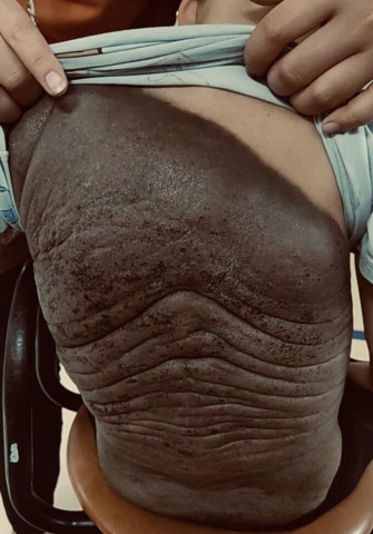 Phẫu thuật tạo hình cho 2 bé trai mắc Nevus (Nơvi) hắc tố bẩm sinh khổng lồ