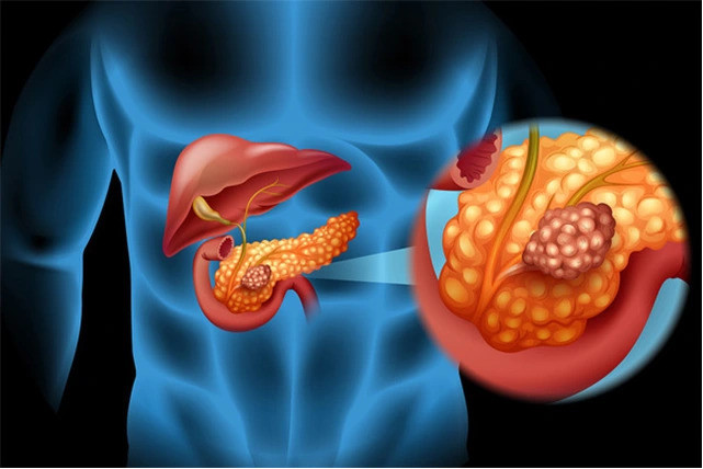 Viêm tụy mạn gây suy giảm chức năng tụy nội tiết và ngoại tiết