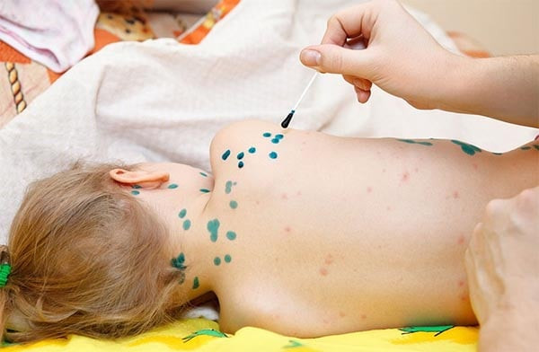 Những thông tin cần biết về bệnh thuỷ đậu