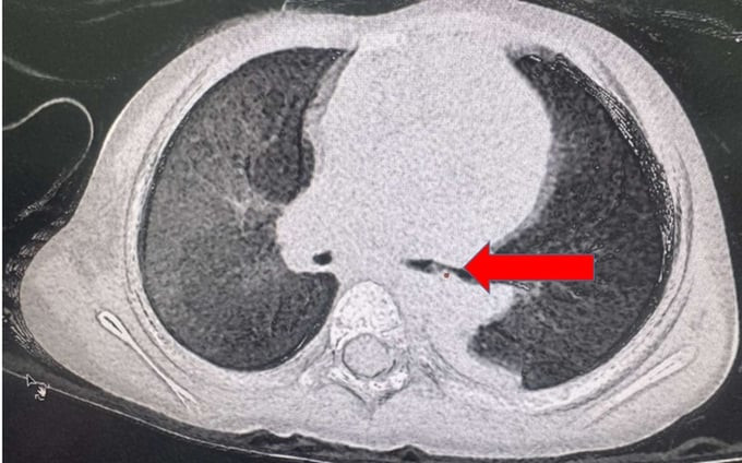 TP. HCM: Bé gái 25 tháng tuổi có dị vật là "miếng thịt" bị "bỏ quên" trong đường thở