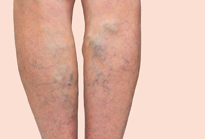 Giãn tĩnh mạch – dấu hiệu cảnh báo hình thành cục máu đông