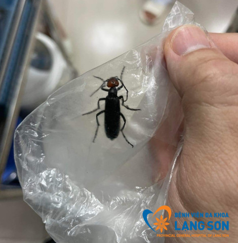 Lạng Sơn: Một bệnh nhân nhân nguy kịch do ăn phải côn trùng lạ