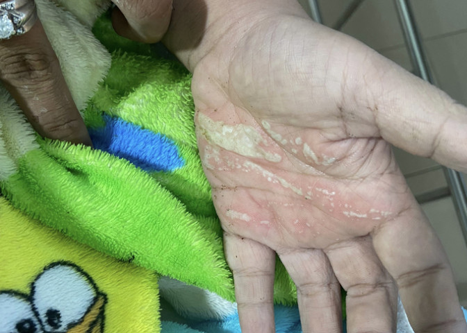 Bình Thuận: Bé trai bị điện giật bỏng tay chân khi gỡ diều vướng vào dây điện
