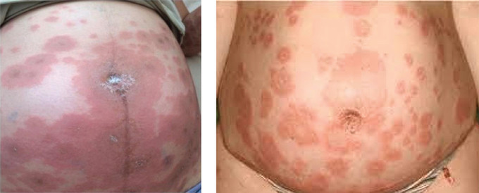 Pemphigoid thai kì là bệnh lý bọng nước tự miễn hiếm gặp