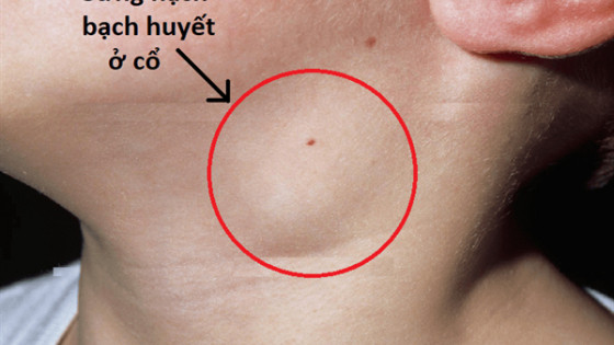 Hỗ trợ điều trị hạch, ung thư hạch bằng Nam y