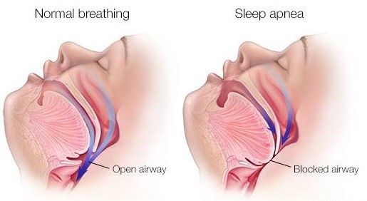 Điều trị ngưng thở khi ngủ