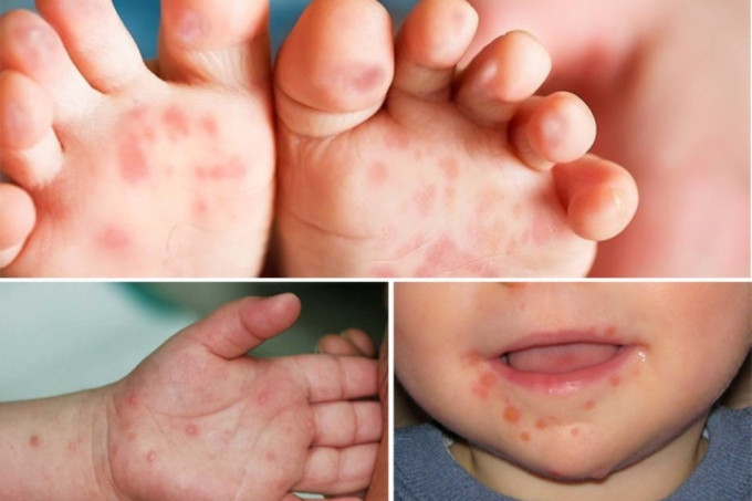 TP. HCM: Một bệnh nhi tử vong nghi do tay chân miệng